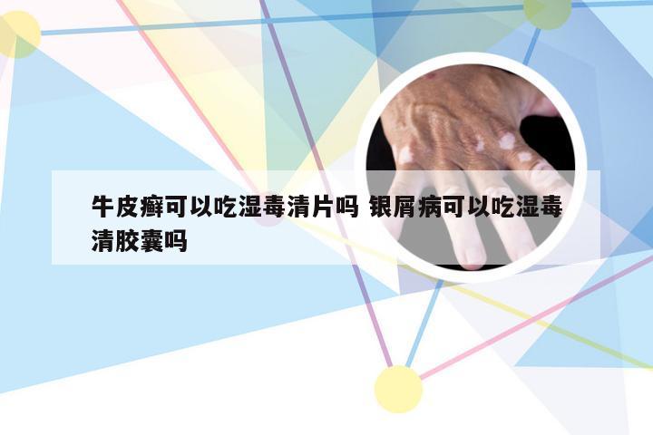 牛皮癣可以吃湿毒清片吗 银屑病可以吃湿毒清胶囊吗