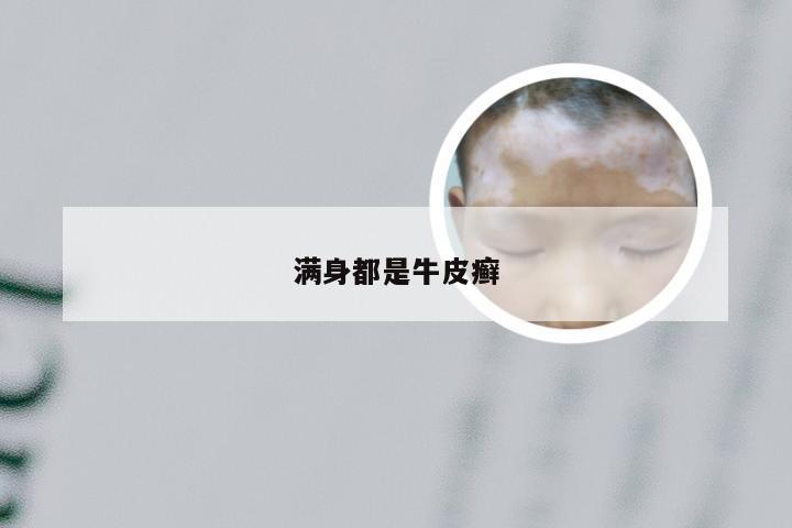 满身都是牛皮癣
