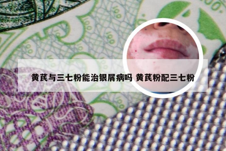 黄芪与三七粉能治银屑病吗 黄芪粉配三七粉