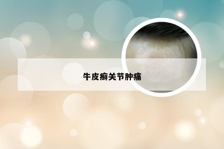 牛皮癣关节肿痛