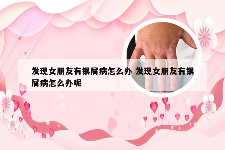 发现女朋友有银屑病怎么办 发现女朋友有银屑病怎么办呢