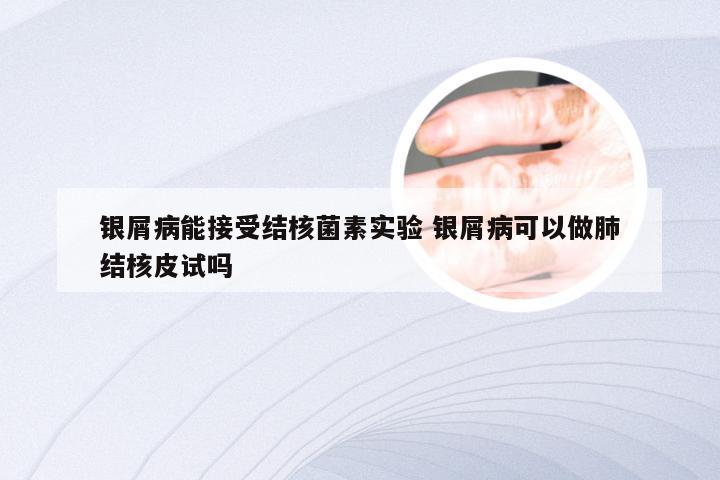 银屑病能接受结核菌素实验 银屑病可以做肺结核皮试吗