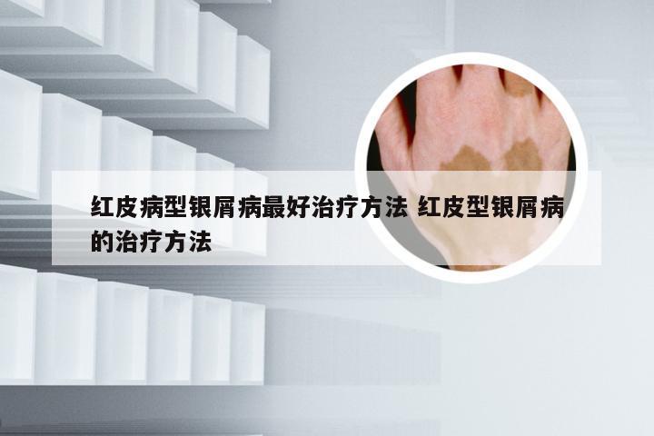 红皮病型银屑病最好治疗方法 红皮型银屑病的治疗方法