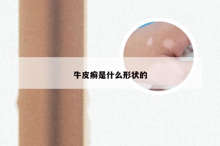 牛皮癣是什么形状的