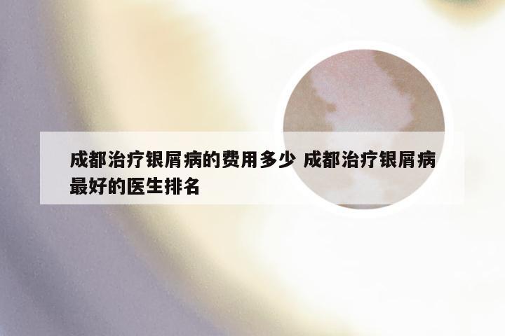 成都治疗银屑病的费用多少 成都治疗银屑病最好的医生排名