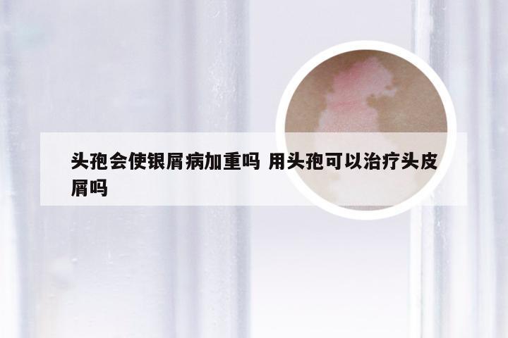 头孢会使银屑病加重吗 用头孢可以治疗头皮屑吗
