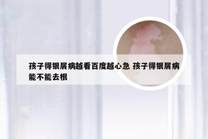 孩子得银屑病越看百度越心急 孩子得银屑病能不能去根