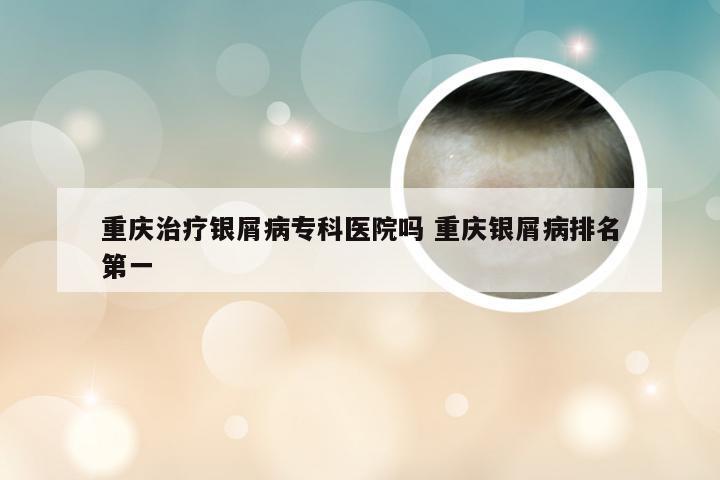 重庆治疗银屑病专科医院吗 重庆银屑病排名第一
