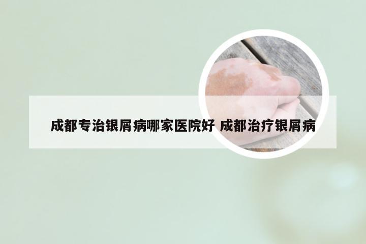 成都专治银屑病哪家医院好 成都治疗银屑病