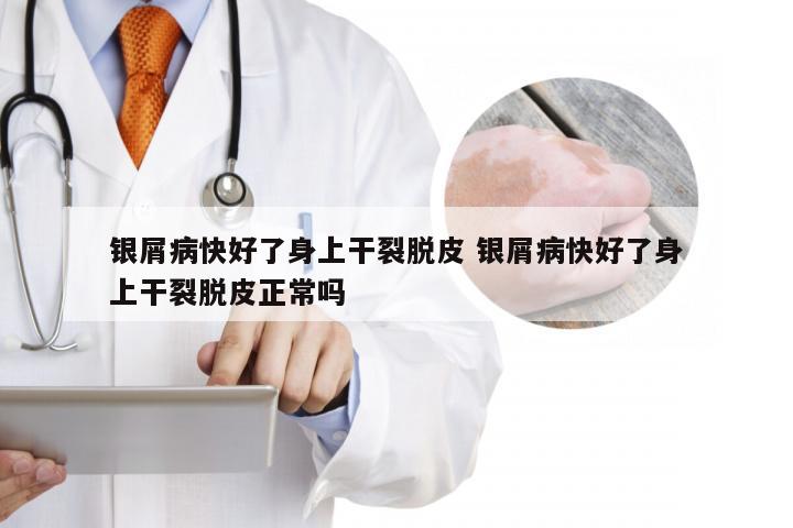 银屑病快好了身上干裂脱皮 银屑病快好了身上干裂脱皮正常吗