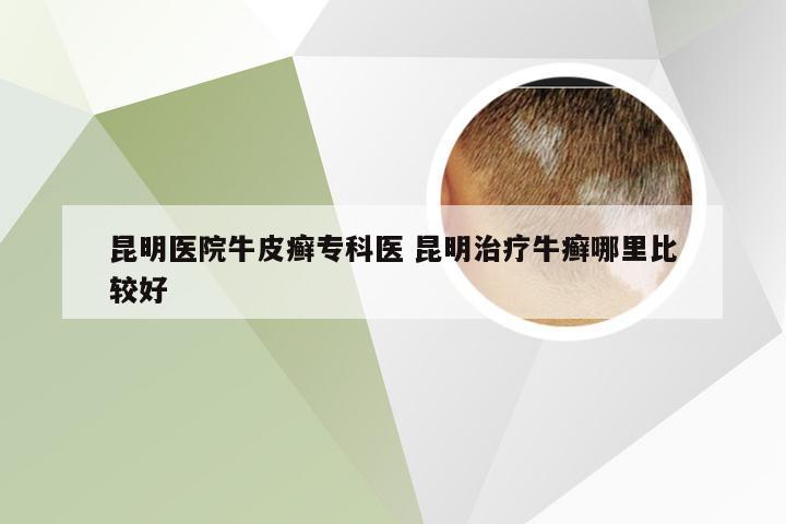 昆明医院牛皮癣专科医 昆明治疗牛癣哪里比较好
