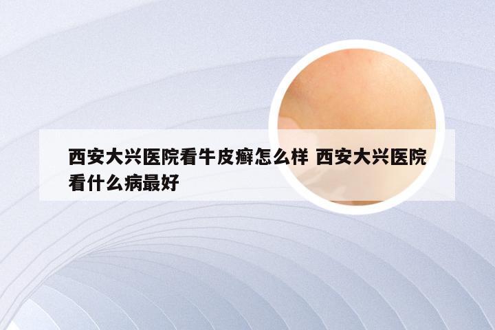 西安大兴医院看牛皮癣怎么样 西安大兴医院看什么病最好