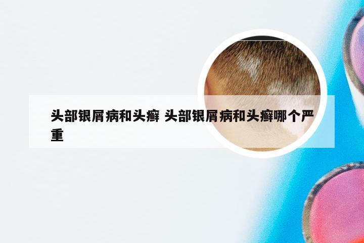 头部银屑病和头癣 头部银屑病和头癣哪个严重