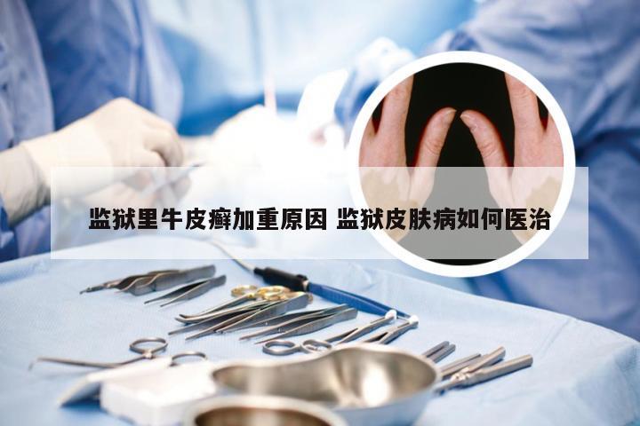 监狱里牛皮癣加重原因 监狱皮肤病如何医治