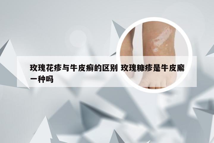 玫瑰花疹与牛皮癣的区别 玫瑰糠疹是牛皮廨一种吗