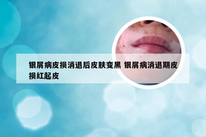 银屑病皮损消退后皮肤变黑 银屑病消退期皮损红起皮