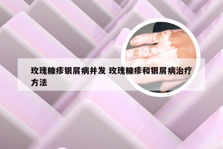 玫瑰糠疹银屑病并发 玫瑰糠疹和银屑病治疗方法