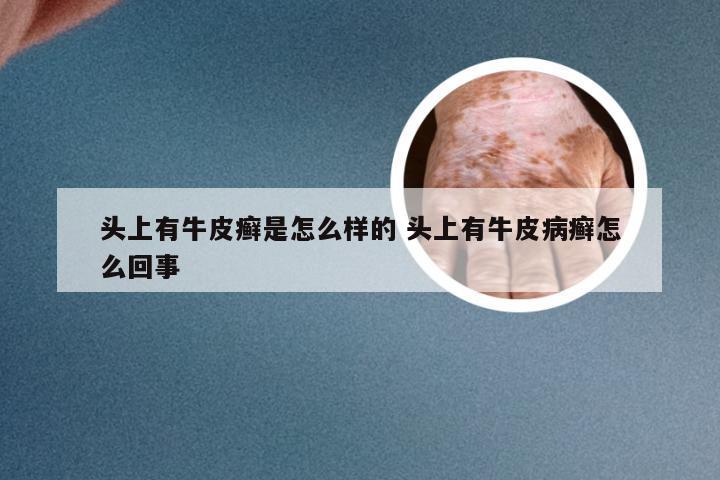 头上有牛皮癣是怎么样的 头上有牛皮病癣怎么回事