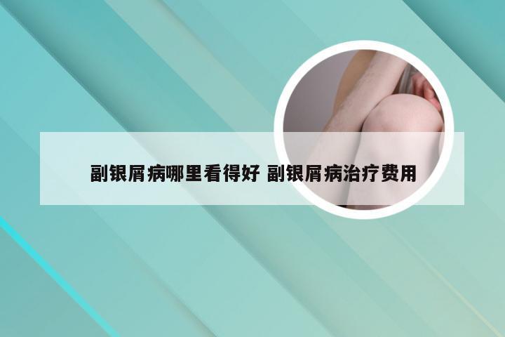 副银屑病哪里看得好 副银屑病治疗费用