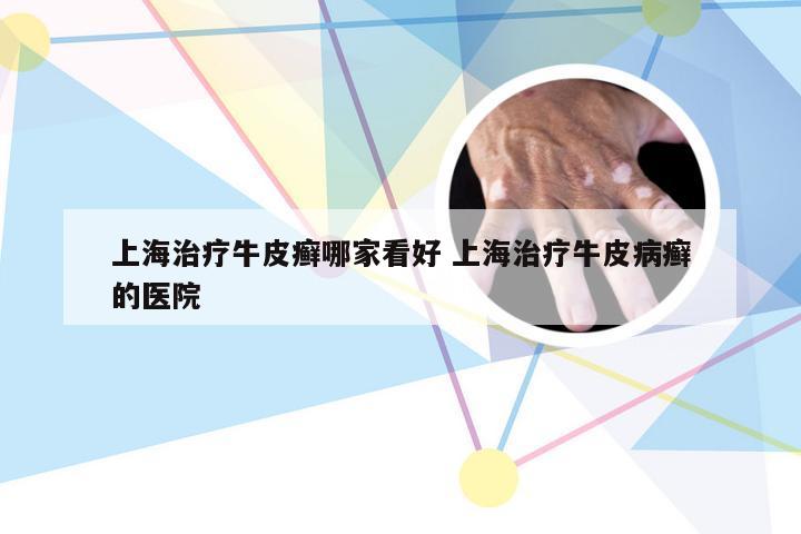 上海治疗牛皮癣哪家看好 上海治疗牛皮病癣的医院