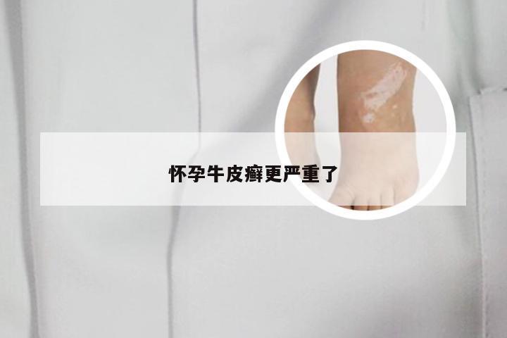 怀孕牛皮癣更严重了