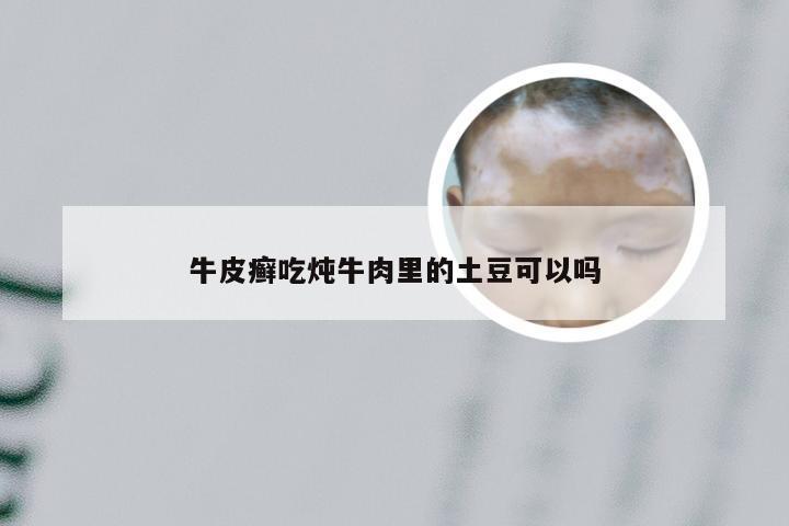 牛皮癣吃炖牛肉里的土豆可以吗