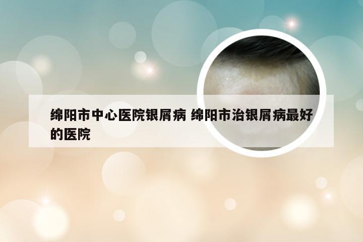 绵阳市中心医院银屑病 绵阳市治银屑病最好的医院