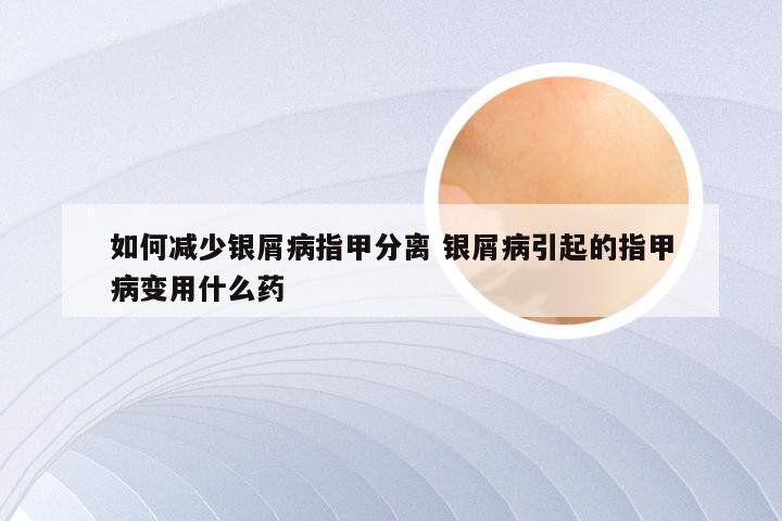 如何减少银屑病指甲分离 银屑病引起的指甲病变用什么药