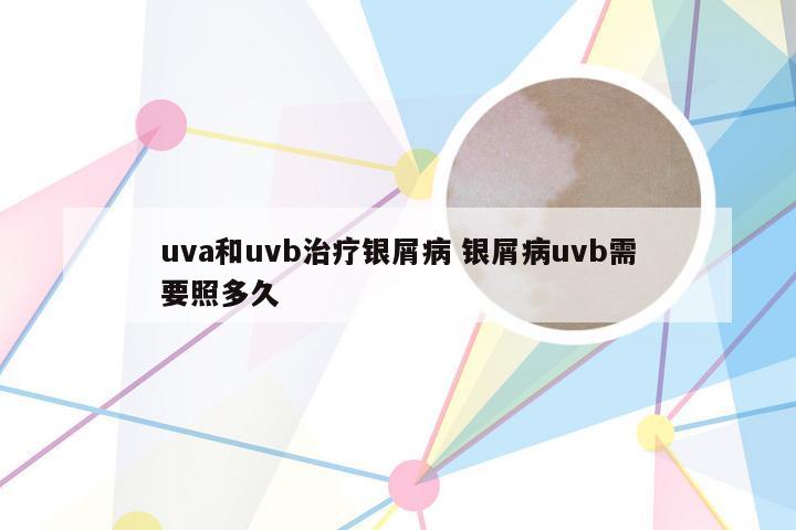 uva和uvb治疗银屑病 银屑病uvb需要照多久