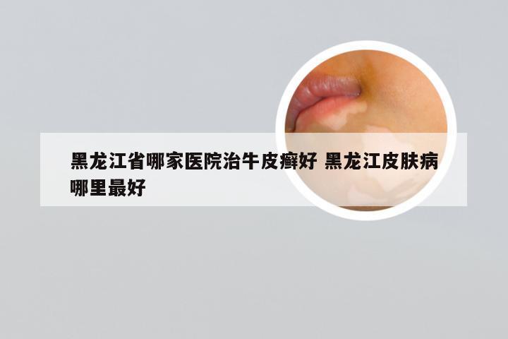 黑龙江省哪家医院治牛皮癣好 黑龙江皮肤病哪里最好