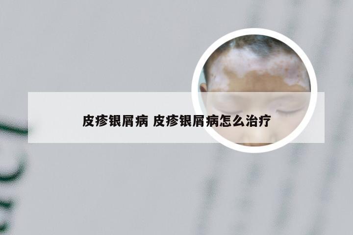 皮疹银屑病 皮疹银屑病怎么治疗