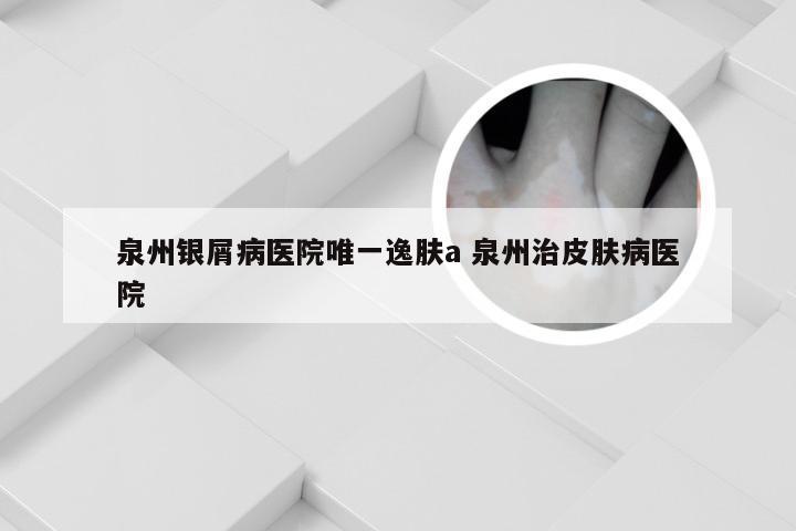 泉州银屑病医院唯一逸肤a 泉州治皮肤病医院