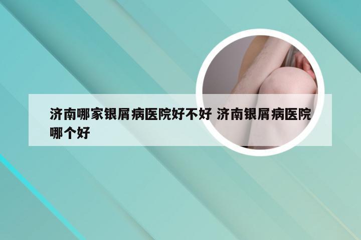 济南哪家银屑病医院好不好 济南银屑病医院哪个好