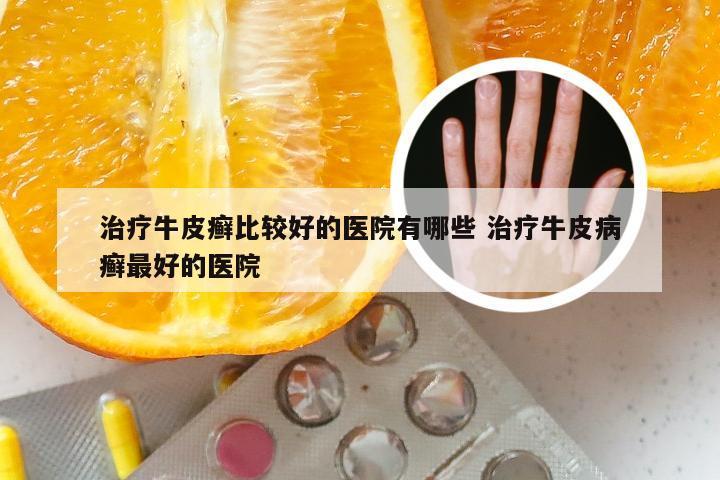 治疗牛皮癣比较好的医院有哪些 治疗牛皮病癣最好的医院