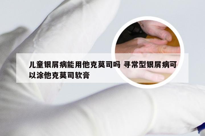 儿童银屑病能用他克莫司吗 寻常型银屑病可以涂他克莫司软膏
