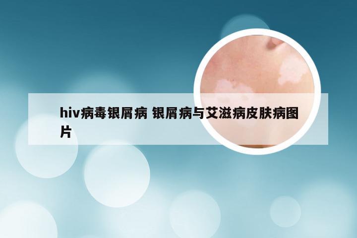 hiv病毒银屑病 银屑病与艾滋病皮肤病图片