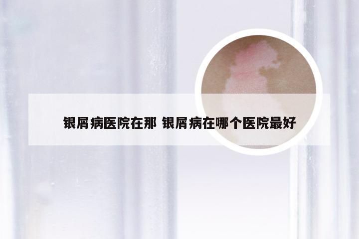 银屑病医院在那 银屑病在哪个医院最好