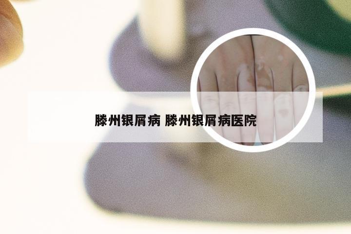 滕州银屑病 滕州银屑病医院