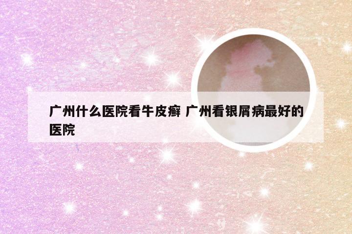 广州什么医院看牛皮癣 广州看银屑病最好的医院