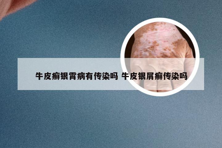 牛皮癣银霄病有传染吗 牛皮银屑癣传染吗
