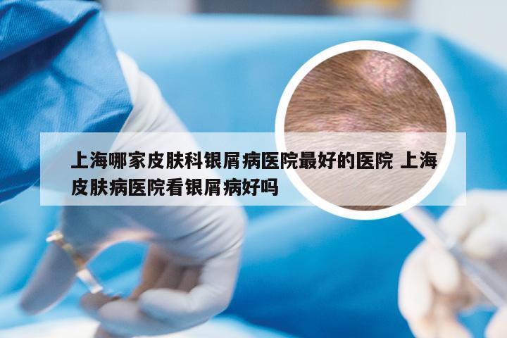 上海哪家皮肤科银屑病医院最好的医院 上海皮肤病医院看银屑病好吗