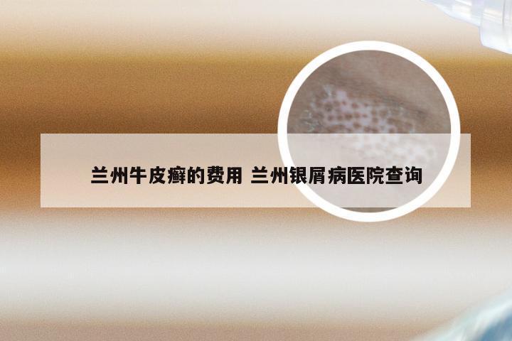 兰州牛皮癣的费用 兰州银屑病医院查询