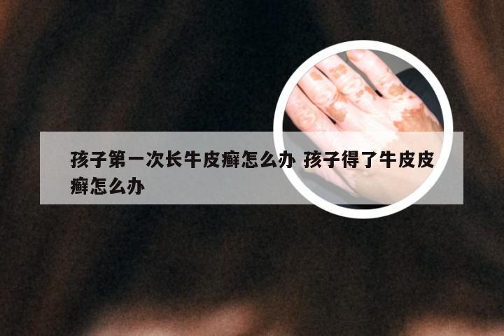 孩子第一次长牛皮癣怎么办 孩子得了牛皮皮癣怎么办