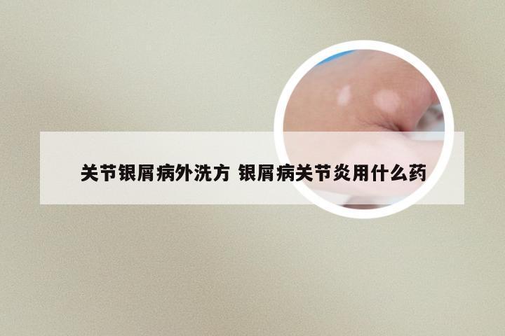 关节银屑病外洗方 银屑病关节炎用什么药