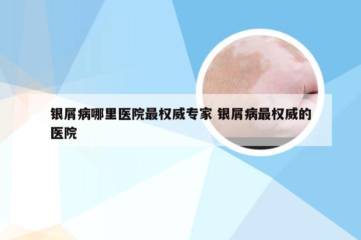 银屑病哪里医院最权威专家 银屑病最权威的医院