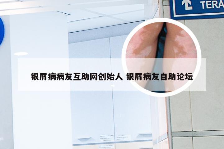 银屑病病友互助网创始人 银屑病友自助论坛