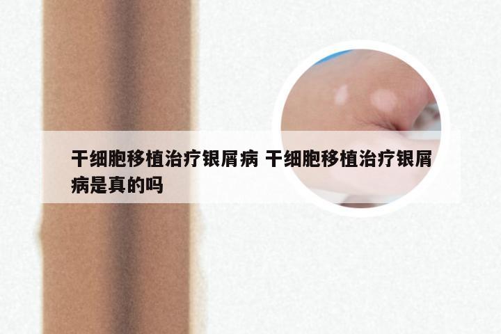 干细胞移植治疗银屑病 干细胞移植治疗银屑病是真的吗