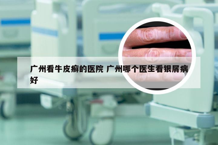 广州看牛皮癣的医院 广州哪个医生看银屑病好