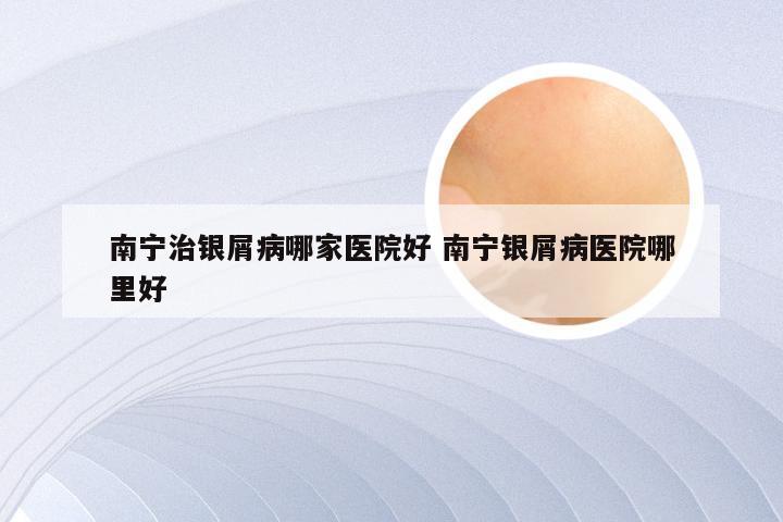 南宁治银屑病哪家医院好 南宁银屑病医院哪里好