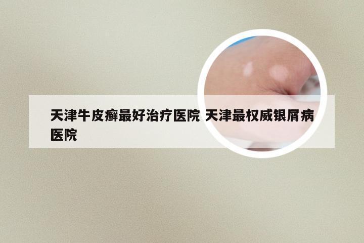 天津牛皮癣最好治疗医院 天津最权威银屑病医院